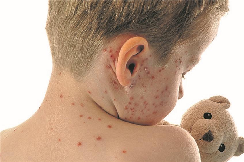 Masern sind eine ernstzunehmende Krankheit mit hohem Fieber und einem typischen Hautausschlag. Bild: Dan Race - Fotolia